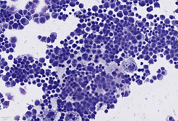 May Grunewald Giemsa (MGG) stain of a cytospin made from the intraocular biopsy taken from the affected area.