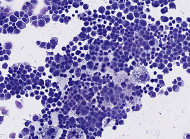 May Grunewald Giemsa (MGG) stain of a cytospin.jpg