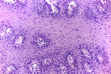 Non-keratinizing stratified squamous epithelium of a soft palate papilloma_low res.jpg