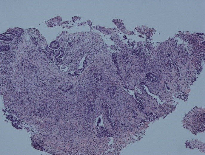 H&E section of the patient’s colonic biopsy showing a malignant tumour (adenocarcinoma).