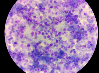Veterinary cytology feline urine with pyelonephritis.jpg