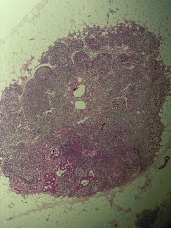 Metastatic Adenocarcinoma in a lymph node.