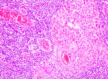 Image from section tissue of breast cancer view in microscopy_lower res for web.jpg