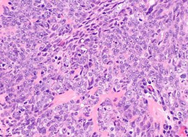300px-Nasopharyngeal_carcinoma_-_alt_--_high_mag.jpg
